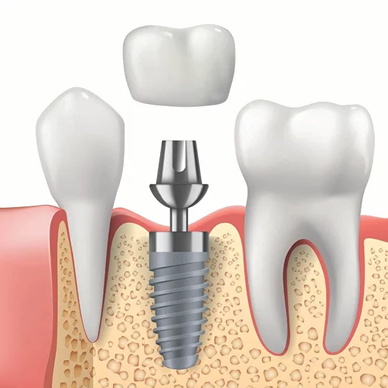 dental crown on implant illustration