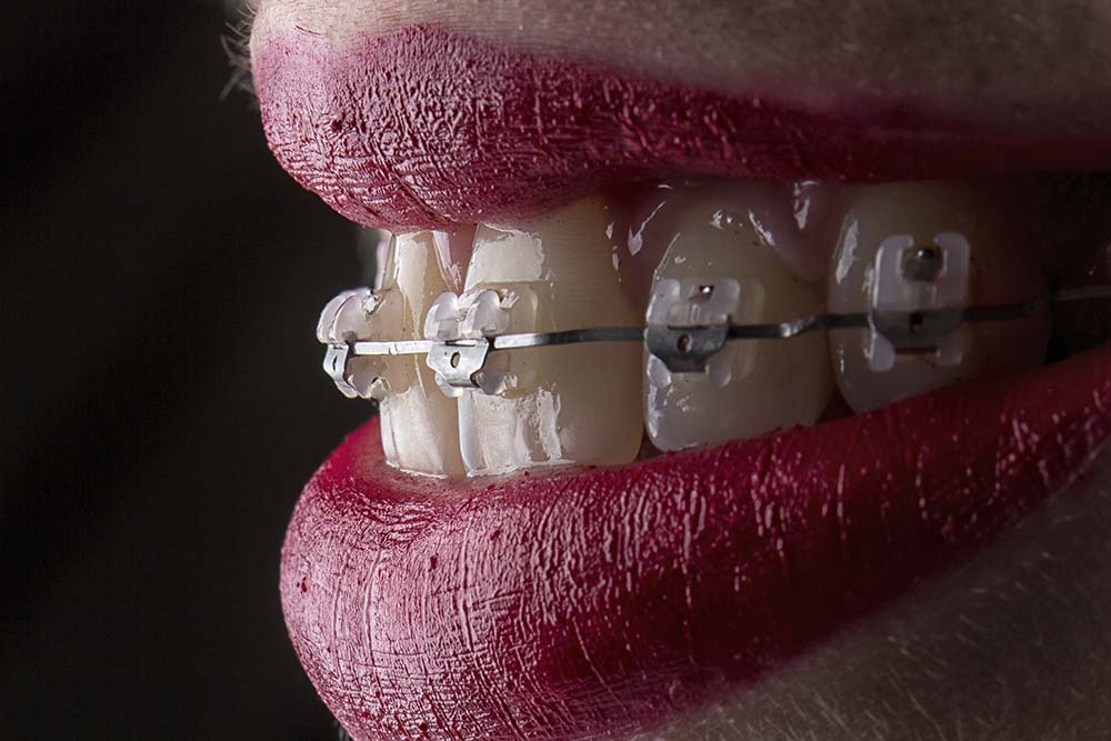 Керамические брекеты практически незаметны на зубах